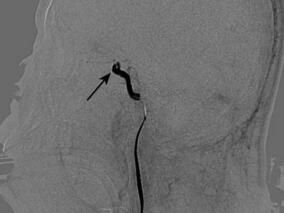 权威专家动脉溶栓联合机械取栓术治疗颈内动脉闭塞患者1例