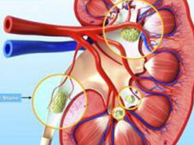 继发于甲状旁腺腺瘤的肾结石1例