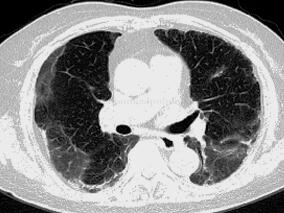 发热、嗜酸性粒细胞增高、肺间质改变,嗜酸性粒细胞性肺病?