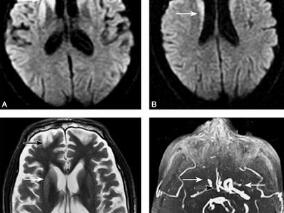 2例大动脉粥样硬化性脑梗死患者合并全身性低灌注后的结局