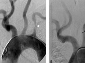 棘手!左侧锁骨下动脉支架断裂伴支架内血栓形成,该如何处理?