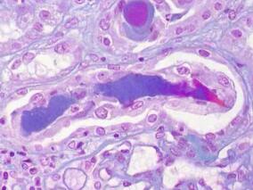 复发和难治多发性骨髓瘤:卡非佐米vs糖皮质激素联合环磷酰胺