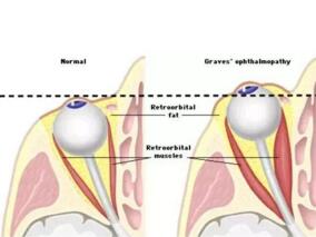 活动性中至重度Graves眼病的治疗进展