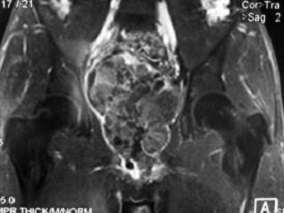 关于前列腺肉瘤 你想知道的都在这个病例中