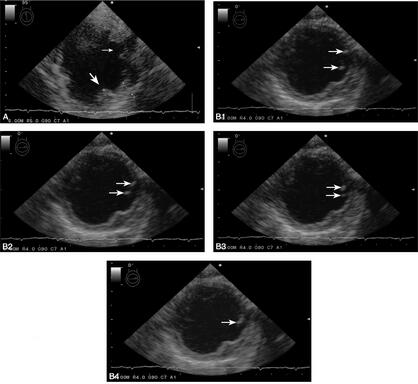 完全符合诊断标准的主动脉粥样硬化复杂斑块致脑栓塞经典病例1例