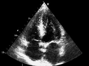 被误诊为吉兰-巴雷综合征的双侧延髓内侧梗死1例