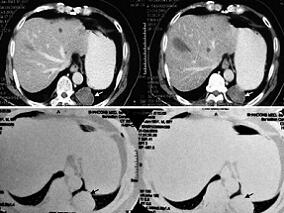 一损俱损!左肺下叶占位半月 病源却不是它