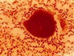 急性期过敏性支气管肺曲霉病：高还是中等剂量糖皮质激素？