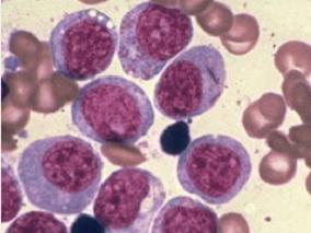 t(8;21)突变AML患者:FA方案可大幅改善生存