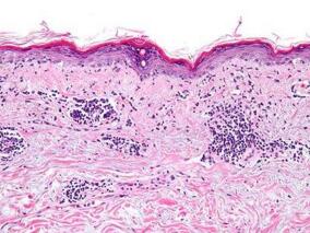 依帕珠单抗治疗中到重度活动期SLE是否安全有效?