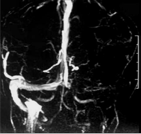 临床表现符合结核性脑膜炎,MRI却显示脑出血,您能侦破是何病吗?