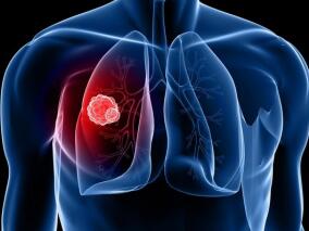 吴一龙教授联合全球顶级专家最新解读：晚期NSCLC的协同治疗潜力