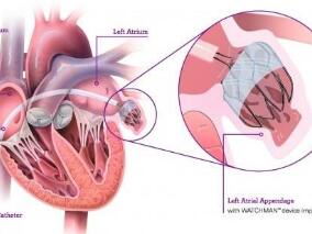 AF患者预防卒中:左心耳封堵术优于抗血小板治疗