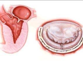 心脏机械瓣膜植入患者:华法林治疗质量影响患者结局