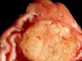 双下肢无力而跌倒 病因是……