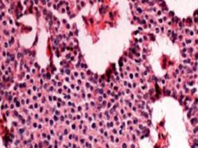 胰腺CT未见明显异常 能否除外胰岛素瘤？