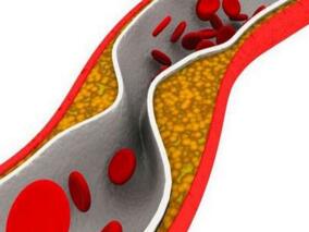 多学科讨论:症状性外周动脉疾病 替卡格雷or氯吡格雷?