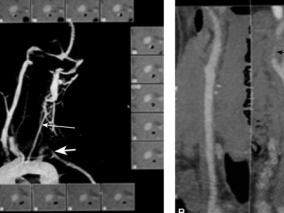 青年患者,TIA起病,不可掉以轻心!
