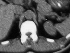 小卒中背后还有大麻烦