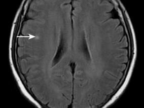 治疗哮喘过程中出现左足力弱:Churg-Strauss综合征惹的祸