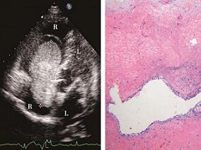 超声心动图令这一恶疾无以遁形