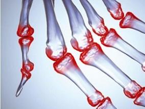 RA患者长期使用阿达木单抗是否安全？