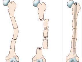 步态异常24年，骨痛12年，加重两个月，如何用药治疗？