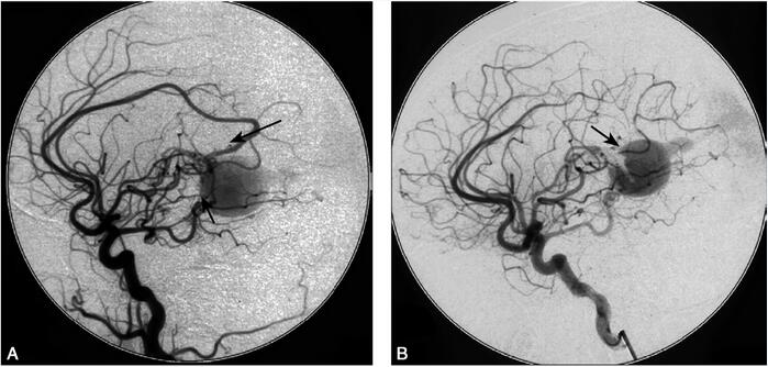 婴幼儿Galen大脑大静脉瘤栓塞术 如何护理?