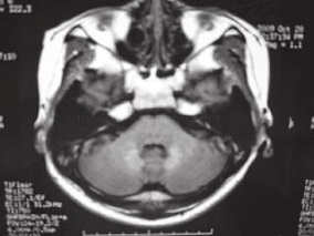发作性四肢抽搐8年 病因是……
