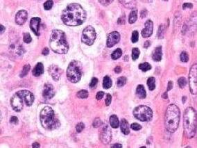 来那度胺治疗成人T细胞淋巴瘤恶化或复发前景喜人