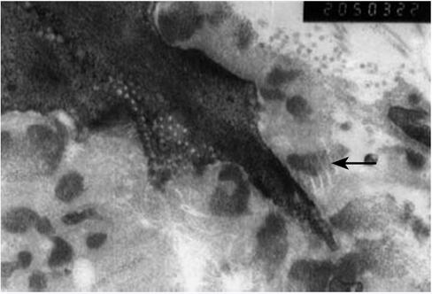 中年女性,无明显卒中危险因素,8年内反复发作卒中4次,这是什么病?