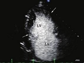 超声心动图确证少见心力衰竭病因