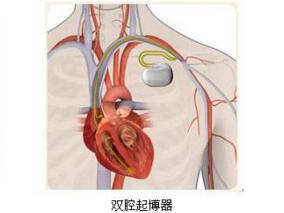 心脏再同步治疗术后囊袋破溃前行修补及起搏器胸大肌下深埋