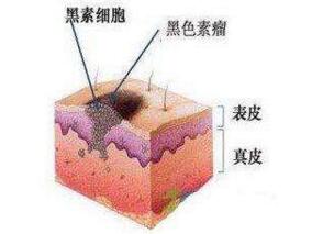 害怕黑色素瘤复发？心理教育大显身手