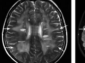 突发右侧肢体无力1个月余 病因罕见