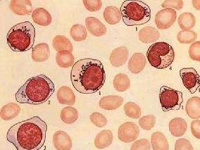难治/复发性HR-MDS合并AML-TD：高剂量来那度胺有效吗？