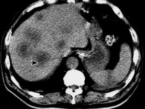 罕见结肠癌合并Trousseau综合征1例