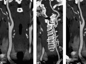 扛重物竟然有这么严重的后果!