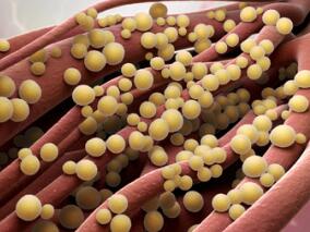 金黄色葡萄球菌菌血症:他汀使用者继续他汀30日死亡率降低一多半