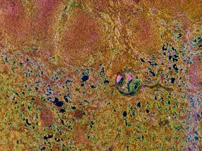 DLBCL伴睾丸受累：利妥昔单抗治疗结局和CNS复发风险