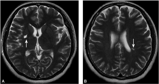 祸不单行!抗磷脂抗体综合征合并复发性脑梗死1例