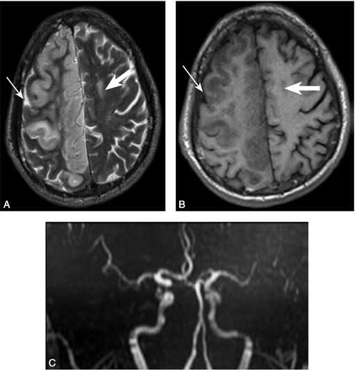 表现为卒中 真凶竟然是……
