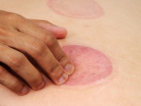 厉害了刮痧!竟能缓解围绝经期症状和改善生活质量