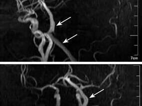 经典病例:椎基底动脉延长扩张综合征如何诊断治疗?