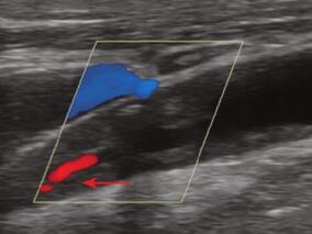 时间上接近的多发梗死灶,除外心脏或主动脉弓栓塞,还应考虑这一点