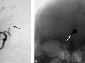 一场车祸引发的严重后遗症8年后才显现出来