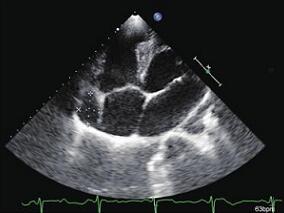 追踪查证巨大右冠状动脉瘤