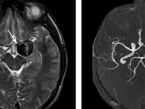 大脑中动脉巨大动脉瘤 鬼斧神工的手术挽救患者