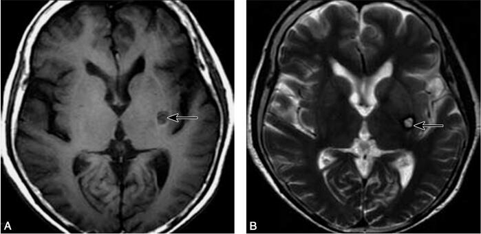 看似偏侧舞蹈症 谁在“垂帘听政”?