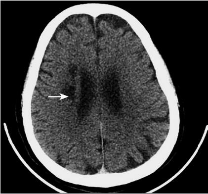 卒中后康复仍感觉生不如死 如何让患者摆脱煎熬?